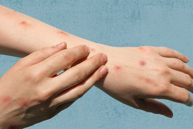 New mpox vaccination site opens in Exeter