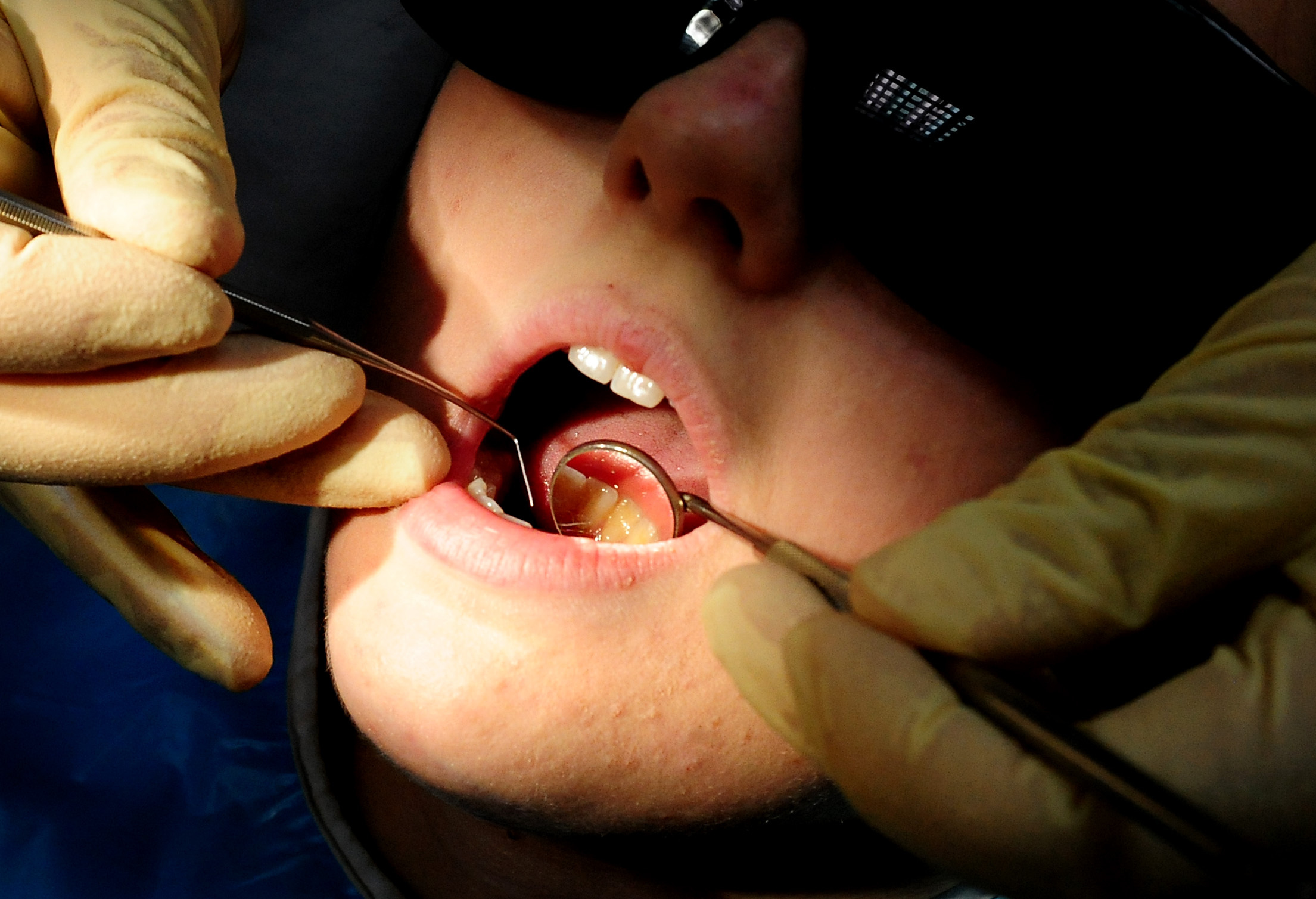 A quarter of children have rotting teeth in Torridge