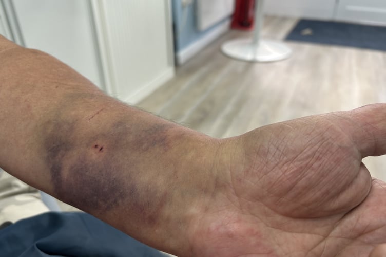 The marks on Neil's wrists left by the police handcuffs.