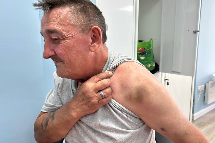 Neil Stout, Tavistock former Big Issue man, with bruising