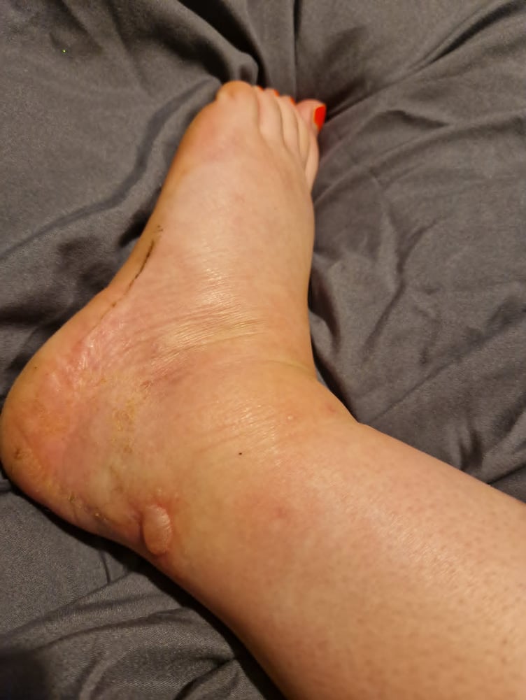 One woman was bitten and she had to take antibiotics