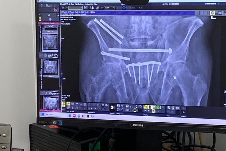 The dramatic X-ray showing the multiple metal pins keeping Arthur Blamey together after his major accident on his Collytown farm.